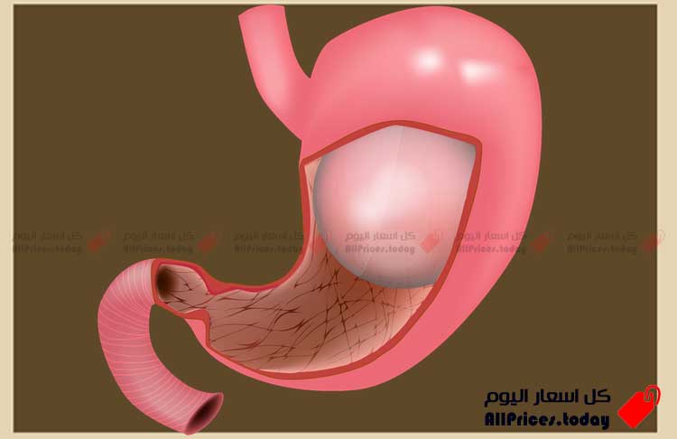 ارخص سعر لعملية بالون المعدة 